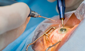cataracts