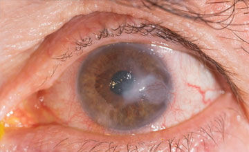 corneal-problems