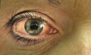 eye-pressure-disease